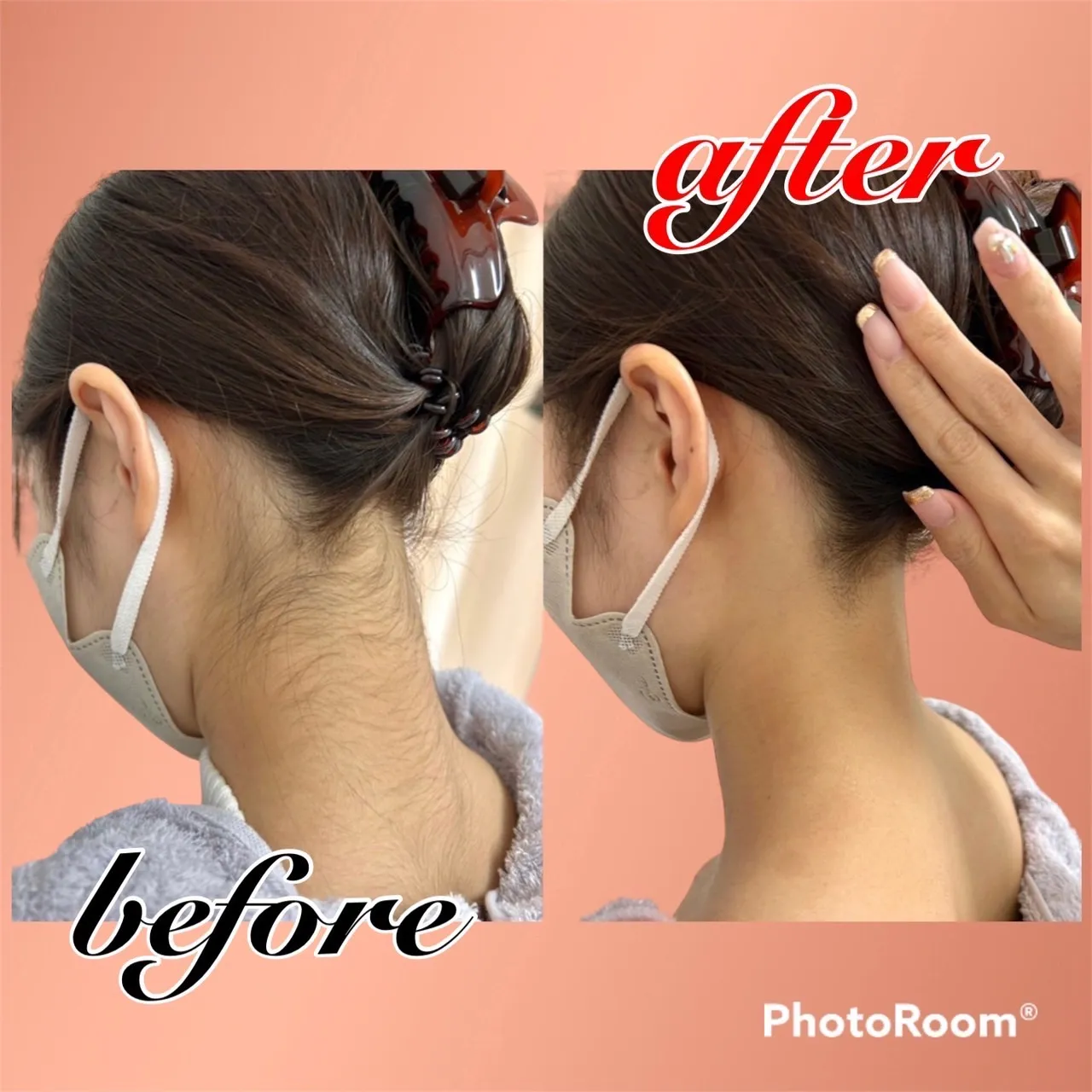 医療脱毛と美容脱毛 ~違いと選び方~