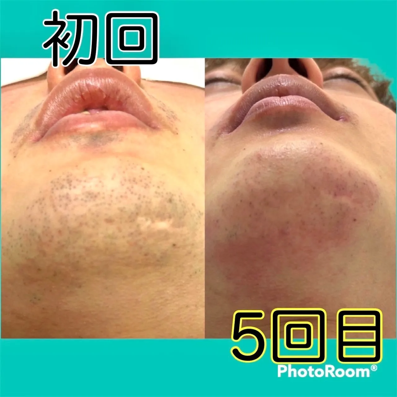 脱毛の効果をあげるには☆